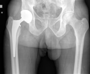 chirurgie de la prothèse totale de hanche à Nice