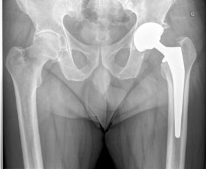 L'intervention de prothèse de hanche - Docteur Gaël Poirée Nice